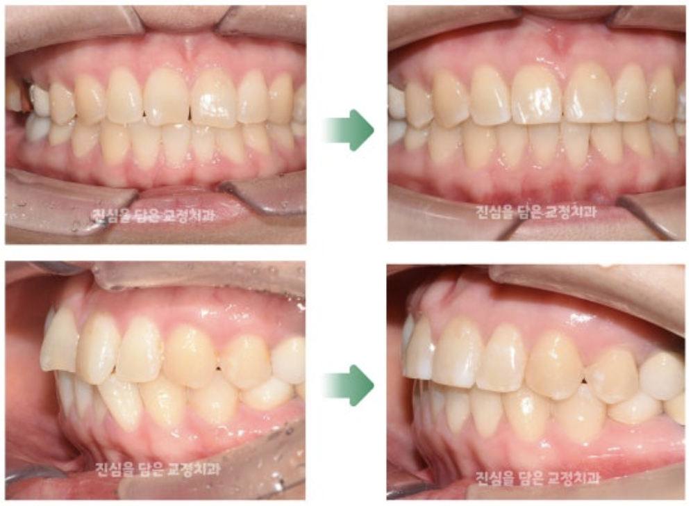 부분교정을 통해 삐뚤어진 앞니를 개선한 30대 환자분의 사례